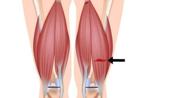 راهکارهای فیزیکی برای درمان مشکل همسترینگ پا